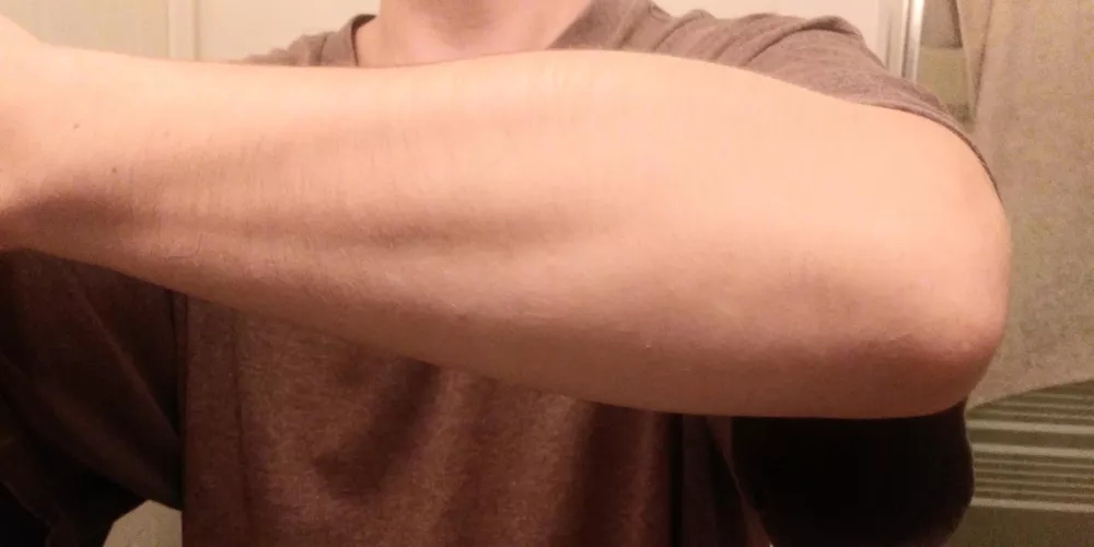 Just started lifting weights and I got this weird growth coming out top of my forearm. Do I stop now or keep going? Just started lifting weights and I got this weird growth coming out top of my forearm. Do I stop now or keep going?