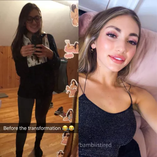 Literally minutes afrer my (f22) lip injections, theyll be less swollen in a few days