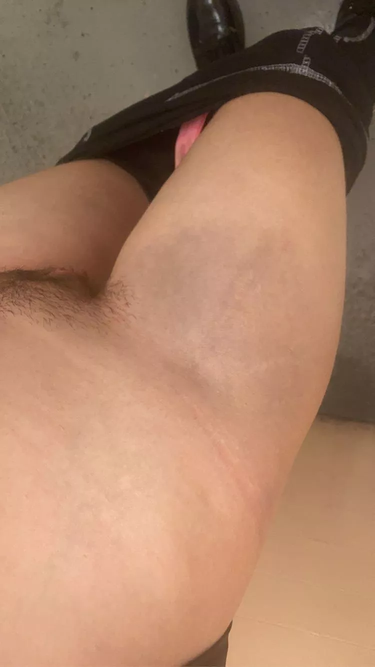 look at my bruised thigh🥲 look at my bruised thigh🥲