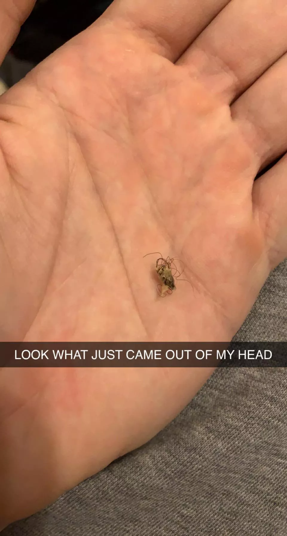 Look at the ingrown my GF just pulled out of the back of my head. I can feel a dip where it used to be