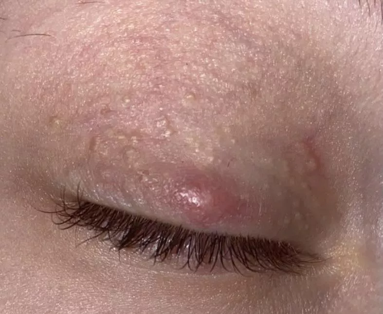 Milia Infected? I stupidly tried popping it. What to do? It's been 3 days of being swollen. I've tried teabags, warm compresses. I've had them for years.