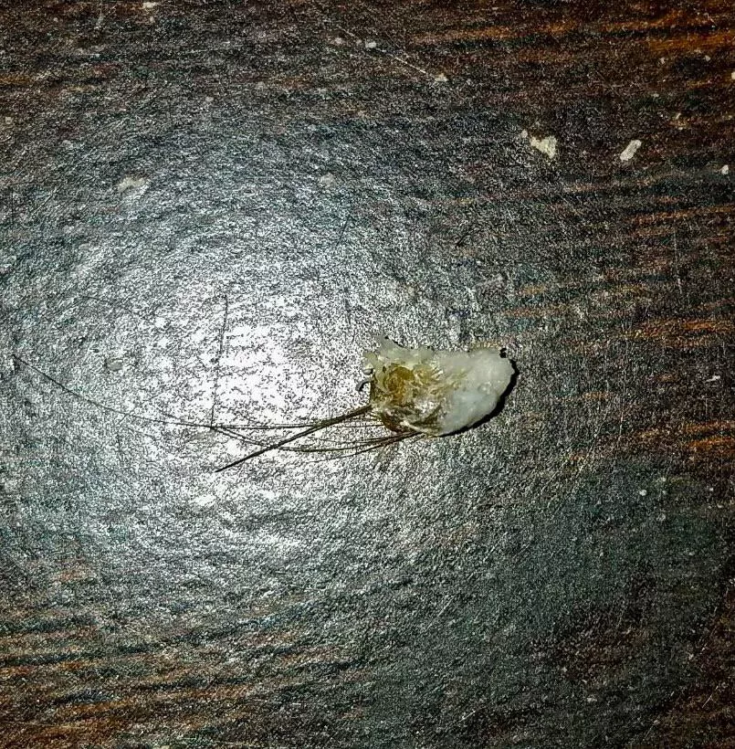 My 16 year old son sent me a photo of his belly button treasure. I’m sad I didn’t get to see the removal and that he didn’t take better photos!