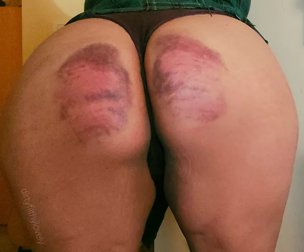 My best bruises to date.