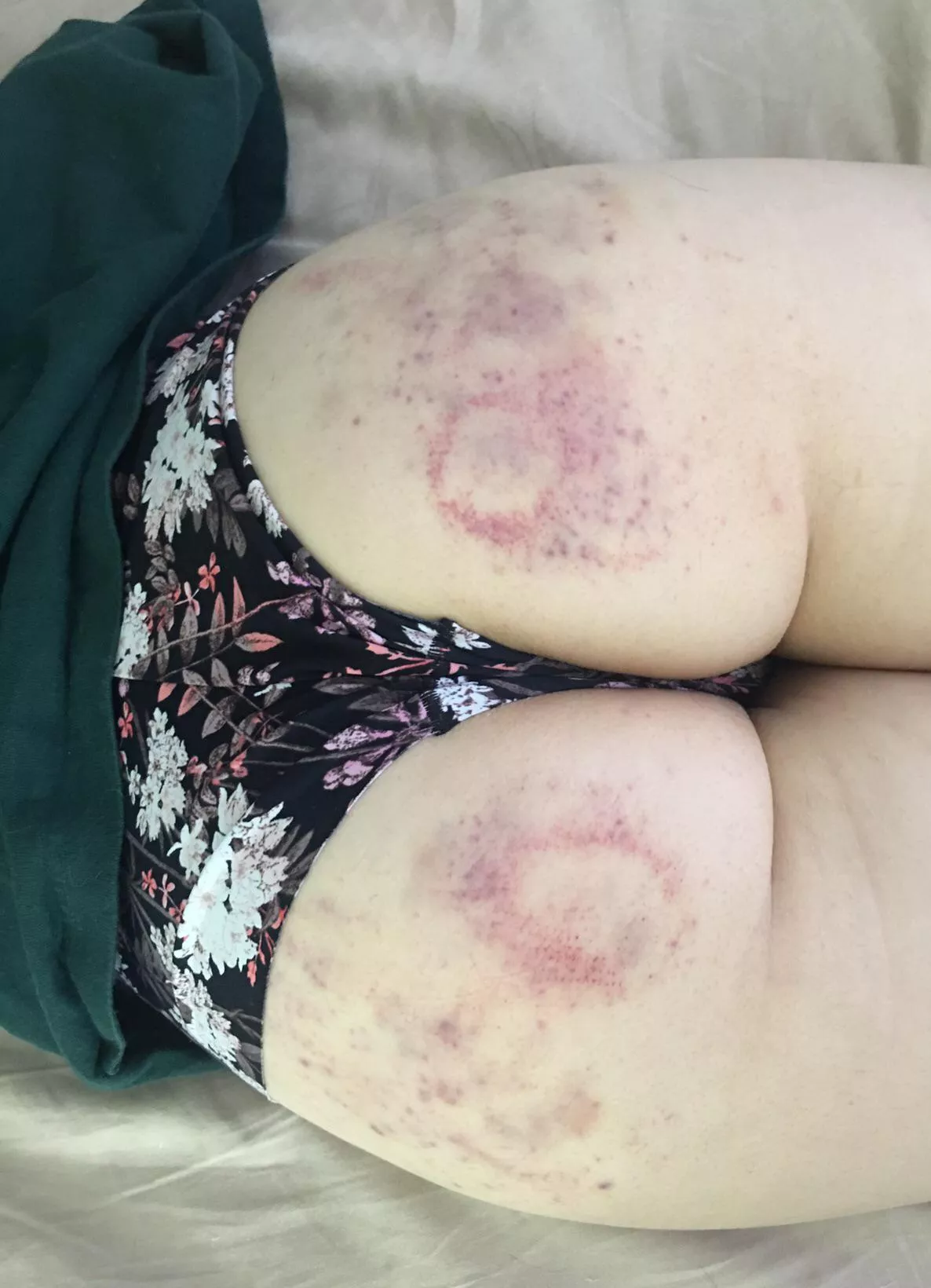 My bruised lil butt, you like? [image]