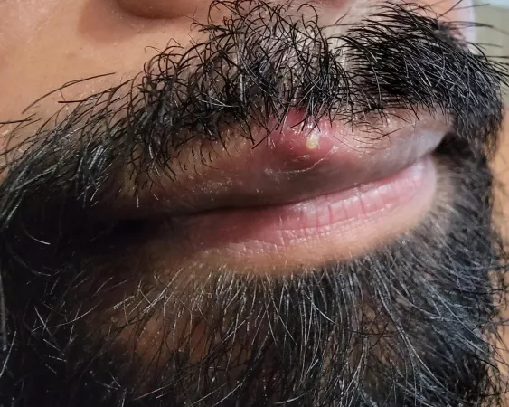 My husband has a juicy one on his lip but won't let me near it đŸ¥º