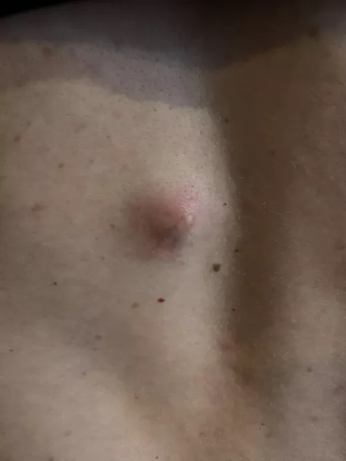 My moms infected cyst. She has a dermatological appointment tomorrow.