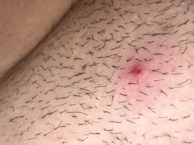 My pubes suck! So many double or triple hairs causing ingrowns! NSFW because beaver.