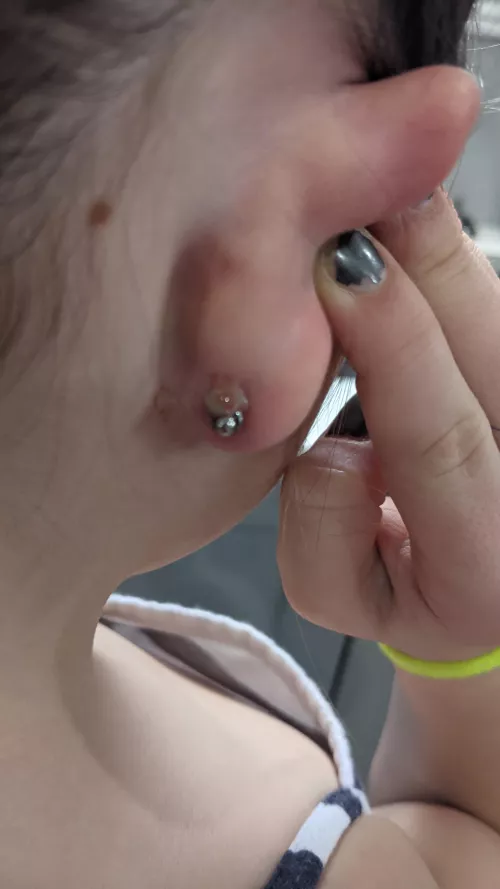 Nasty pop from my daughter's earring. Wish I had of got it on video, but she was having a fit!