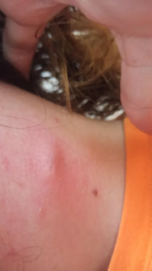 Neck bump? Cyst? Week later. Only hurts if I try to