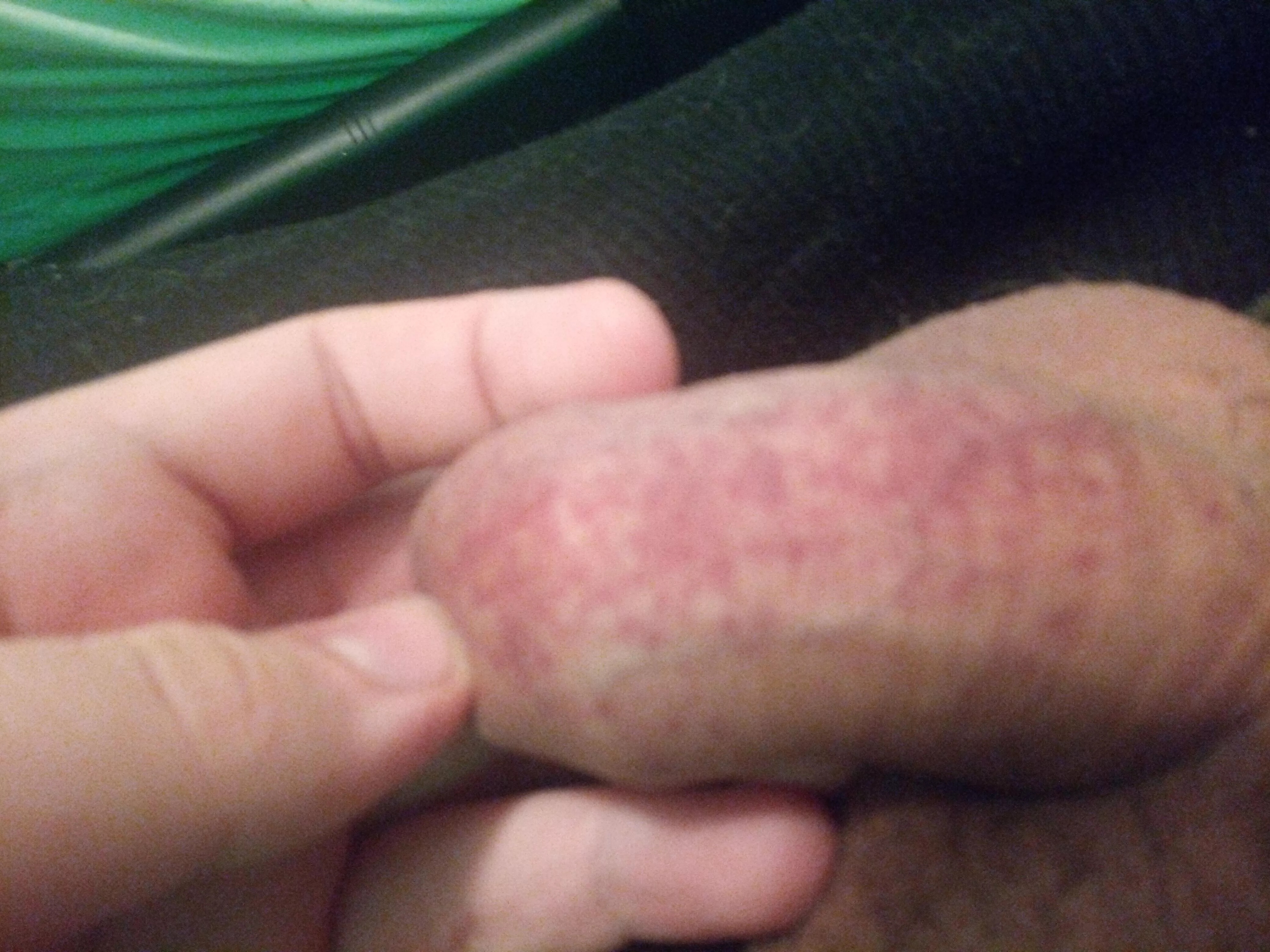 New to pumping and need help (petechiae appears after every time a try cock pumping ) New to pumping and need help (petechiae appears after every time a try cock pumping )