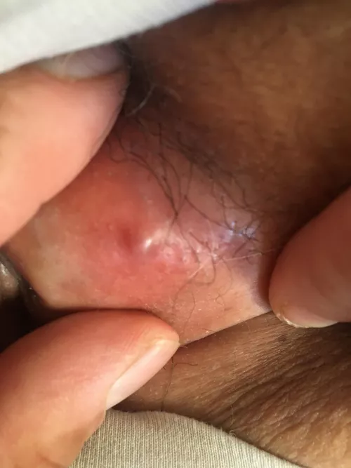 NSFW for my nether region.Not sure what it is but no luck popping yet tried 3 times.Hurts like a mf