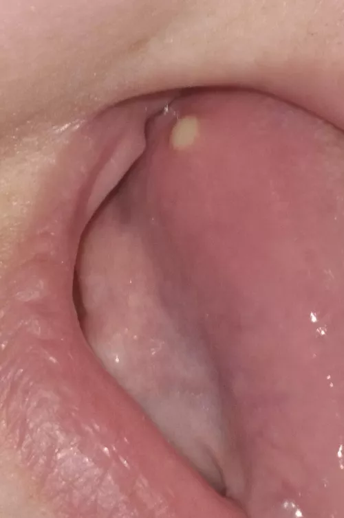 On the tongue, finally popped on its own but ewwww