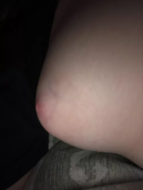 Pale areolas Pale areolas