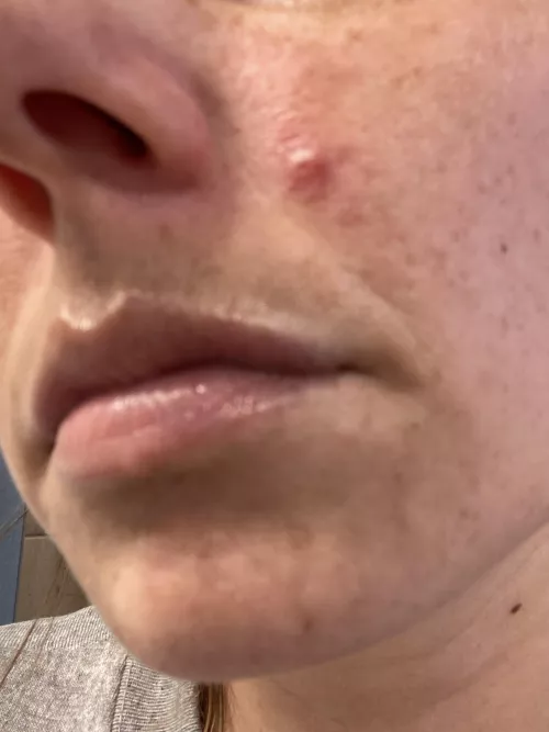 Period pimple. It keeps getting angrier. Some puss surfaced, not a lot. Hurts to even touch.