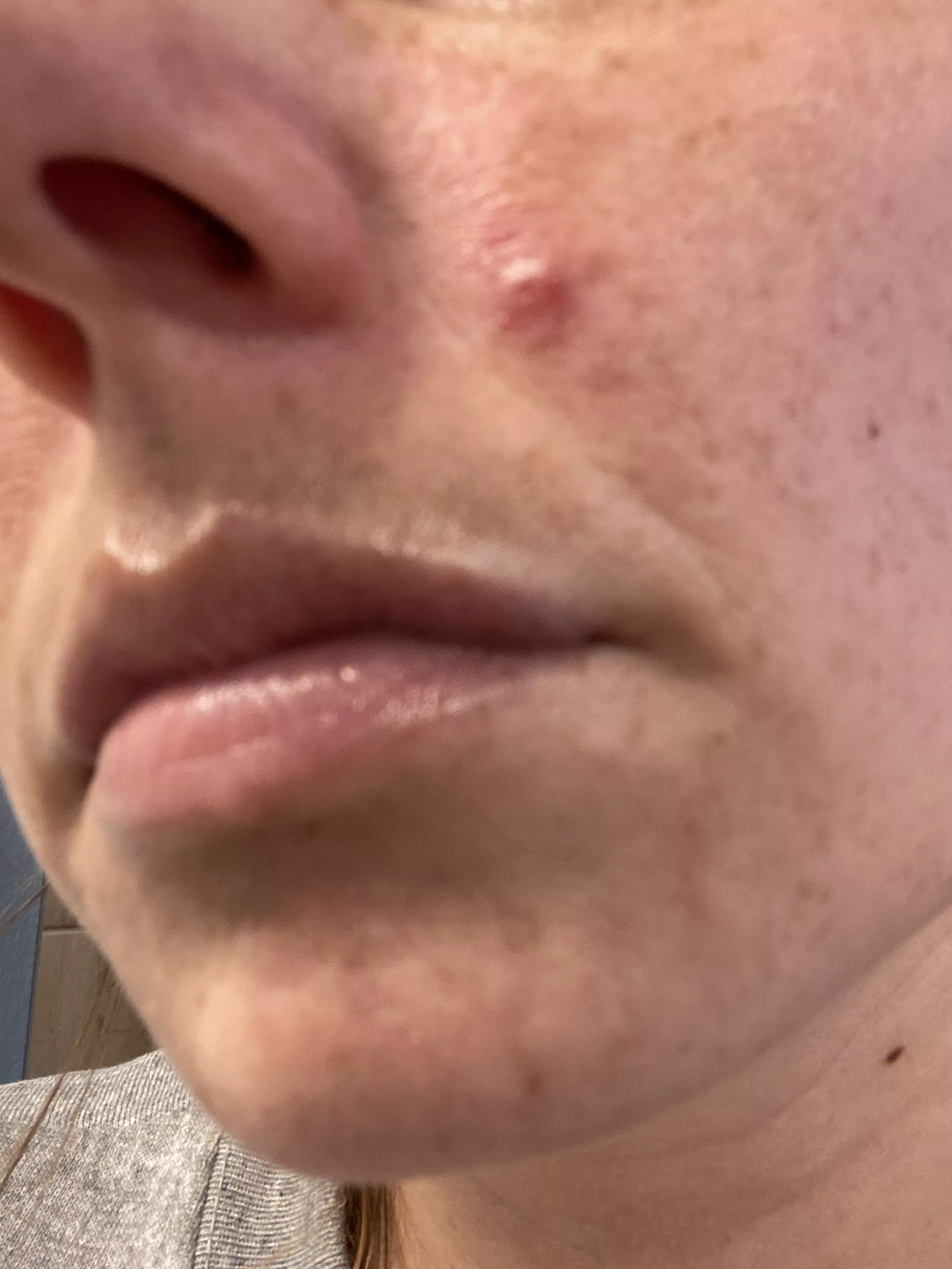 Period pimple. It keeps getting angrier. Some puss surfaced, not a lot. Hurts to even touch.