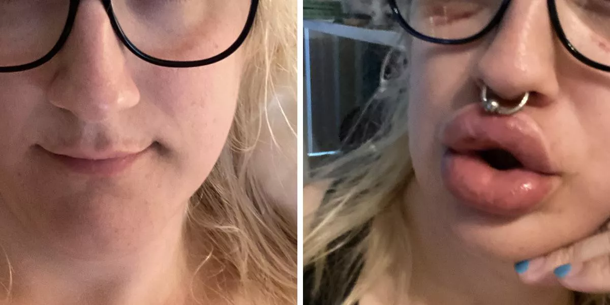 Permanent Lip Aug - Had extra collagen and fat from surgery put in my lips - I’ll have these pillows forever 👄 Permanent Lip Aug - Had extra collagen and fat from surgery put in my lips - I’ll have these pillows forever 👄