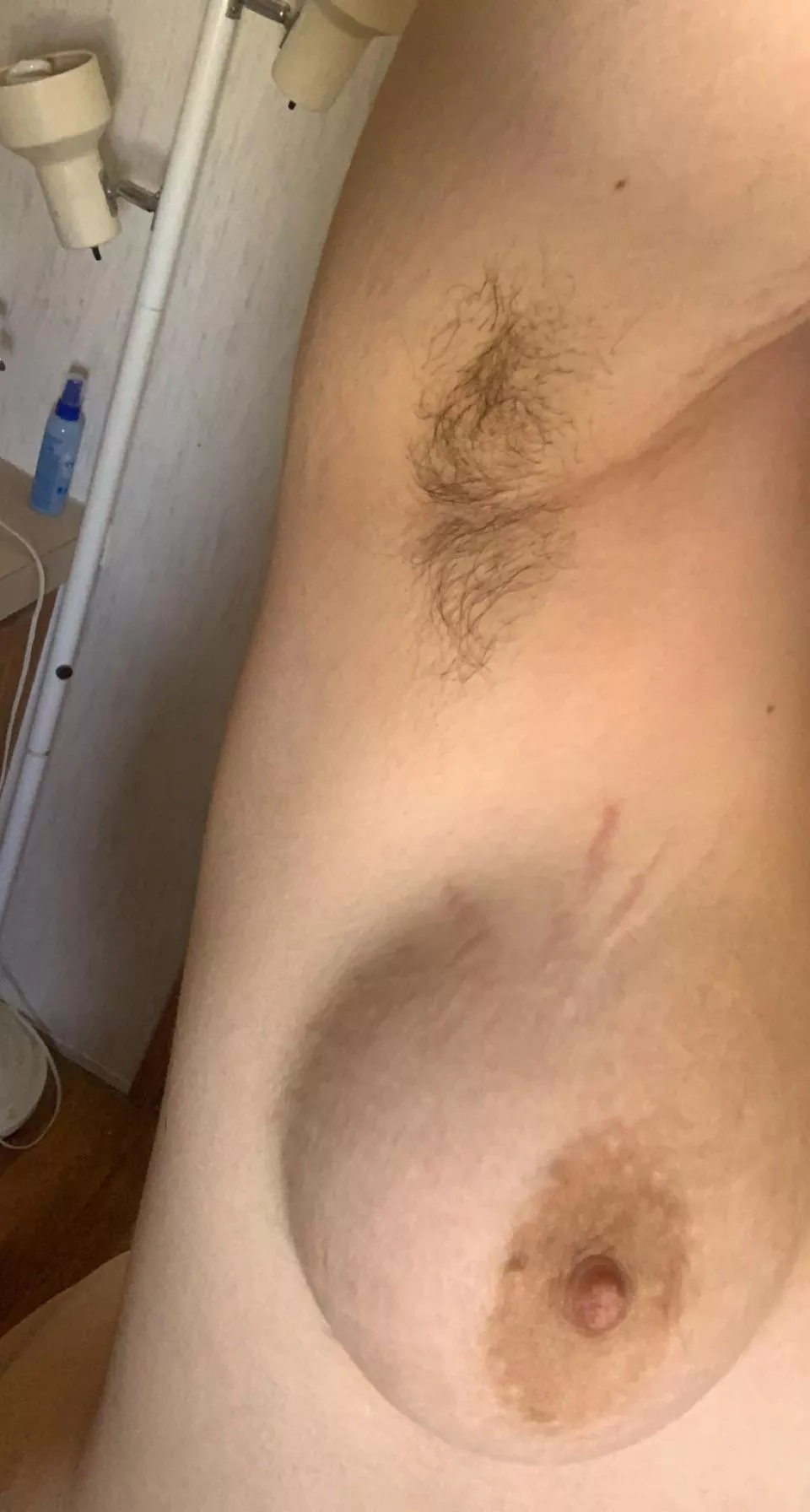 Pits and stretch marks