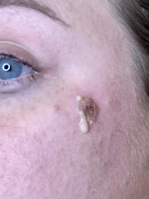 Popped my infected pimple turned abscess. Sooo satisfying and equally disgusting.