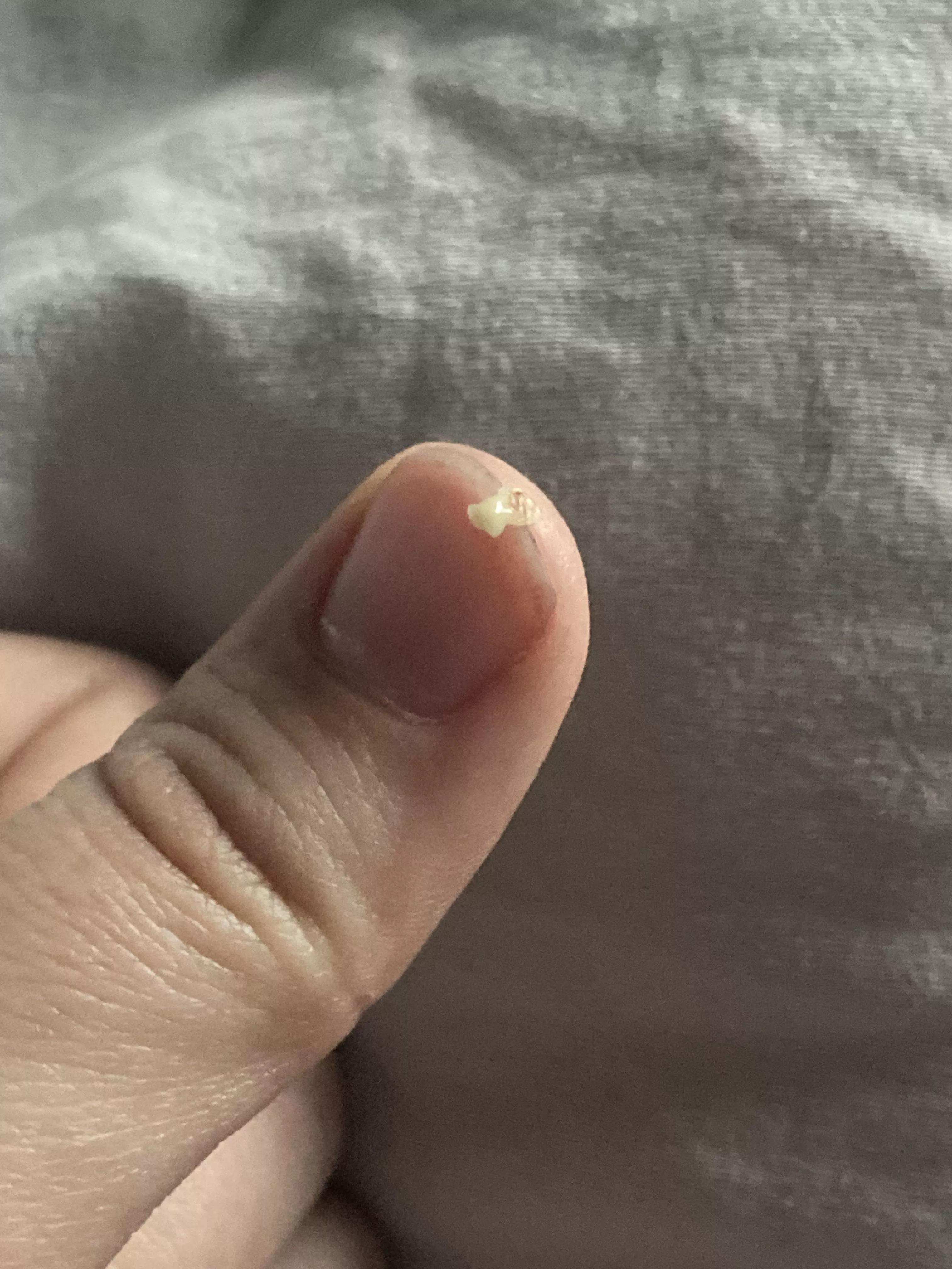 Pulled this new friend out of my nose a few minutes ago (A cyst according to my sister, though we may be wrong)