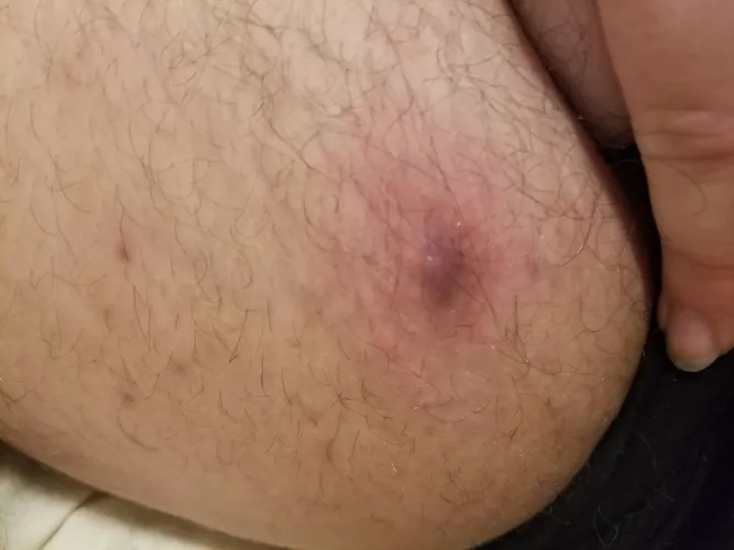 Really want to pop it but probs shouldn't. Doesn't hurt much at least