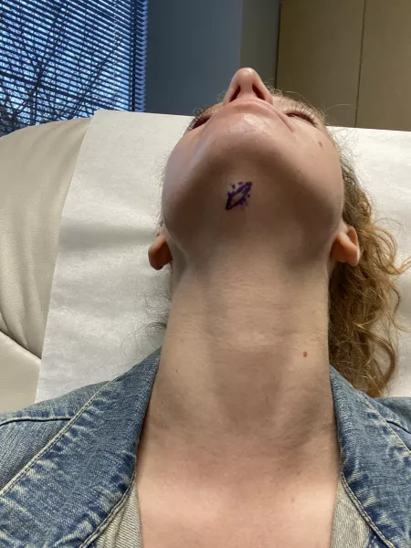 Removal today! I’m getting this little cyst (?) removed today! I’m not allowed to get video, but I will update with a picture of the excised mass. Wish me luck!