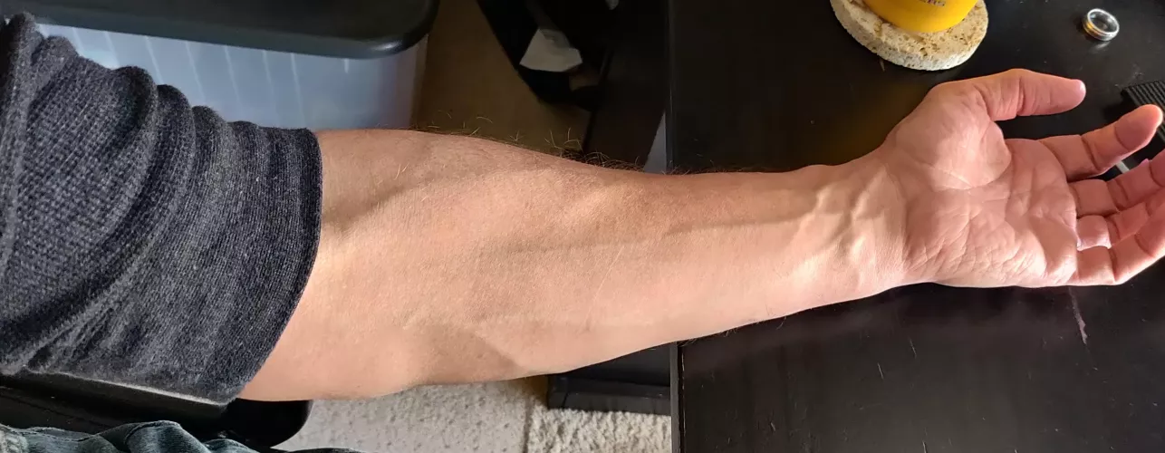 Resting my arm at work Resting my arm at work