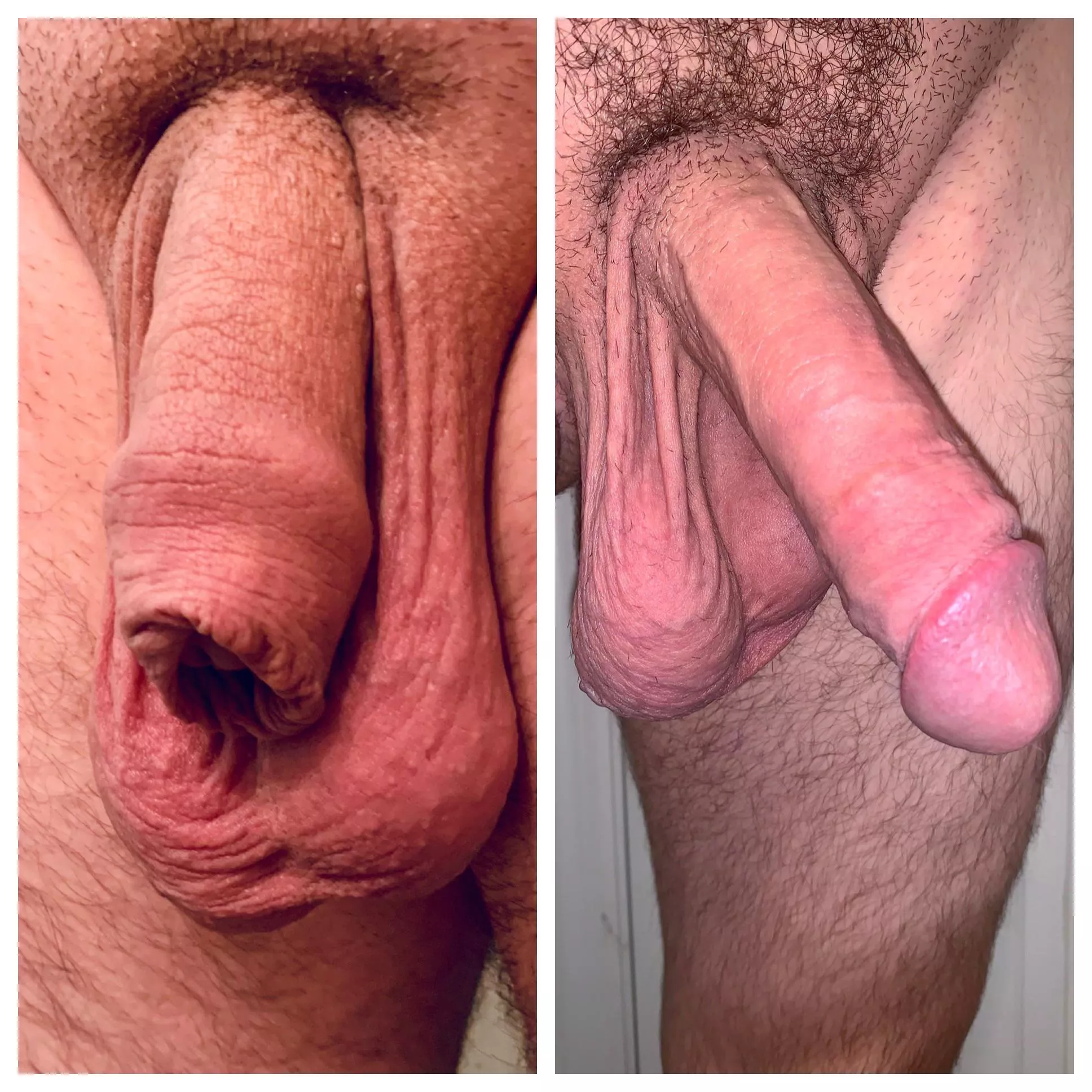 Coverage index foreskin