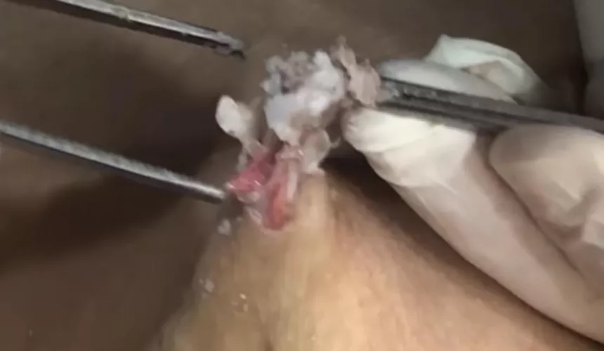 Savage attempted removal of epidermal cysts WARNING It’s unbelievably frustrating & had very scary use of rat tooth tweezers! Link in comments.