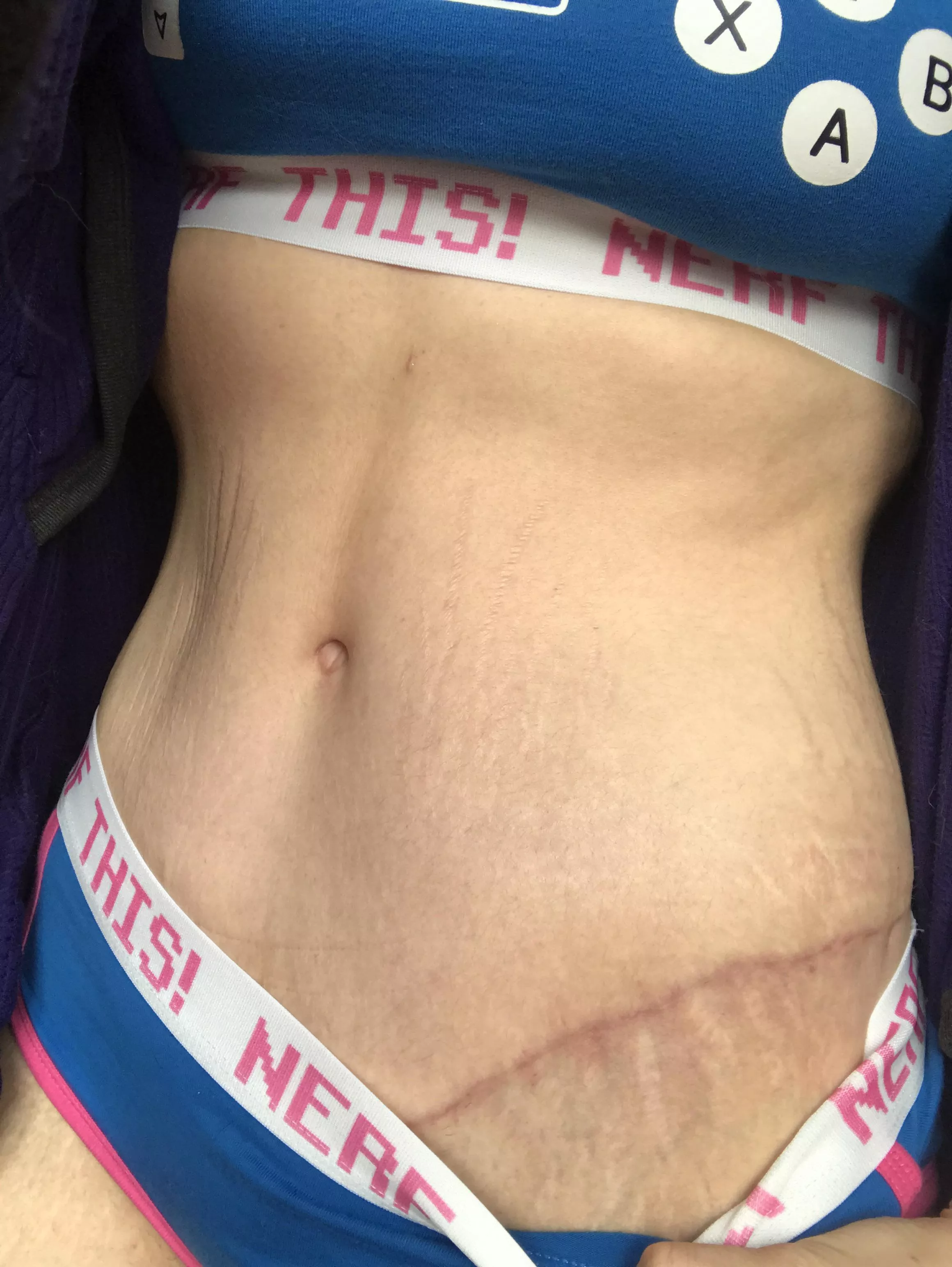 Stretch Marks Fetish