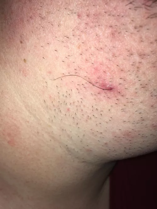 Scratched what I thought was some dead skin from an old bump on my neck. This hair came with it.
