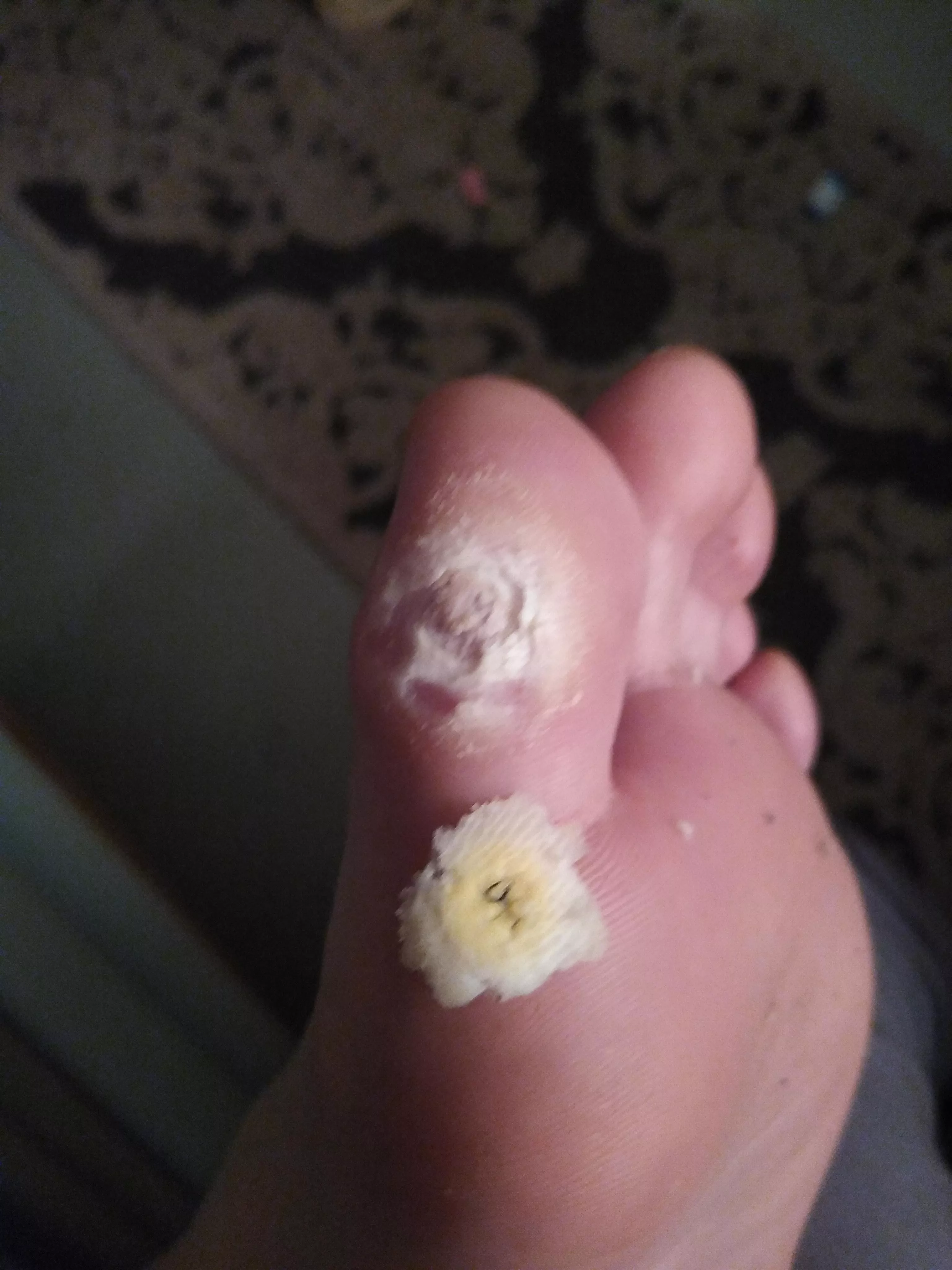 Second time trying to remove a corn on my big toe. Used salicylic acid patches for a week.