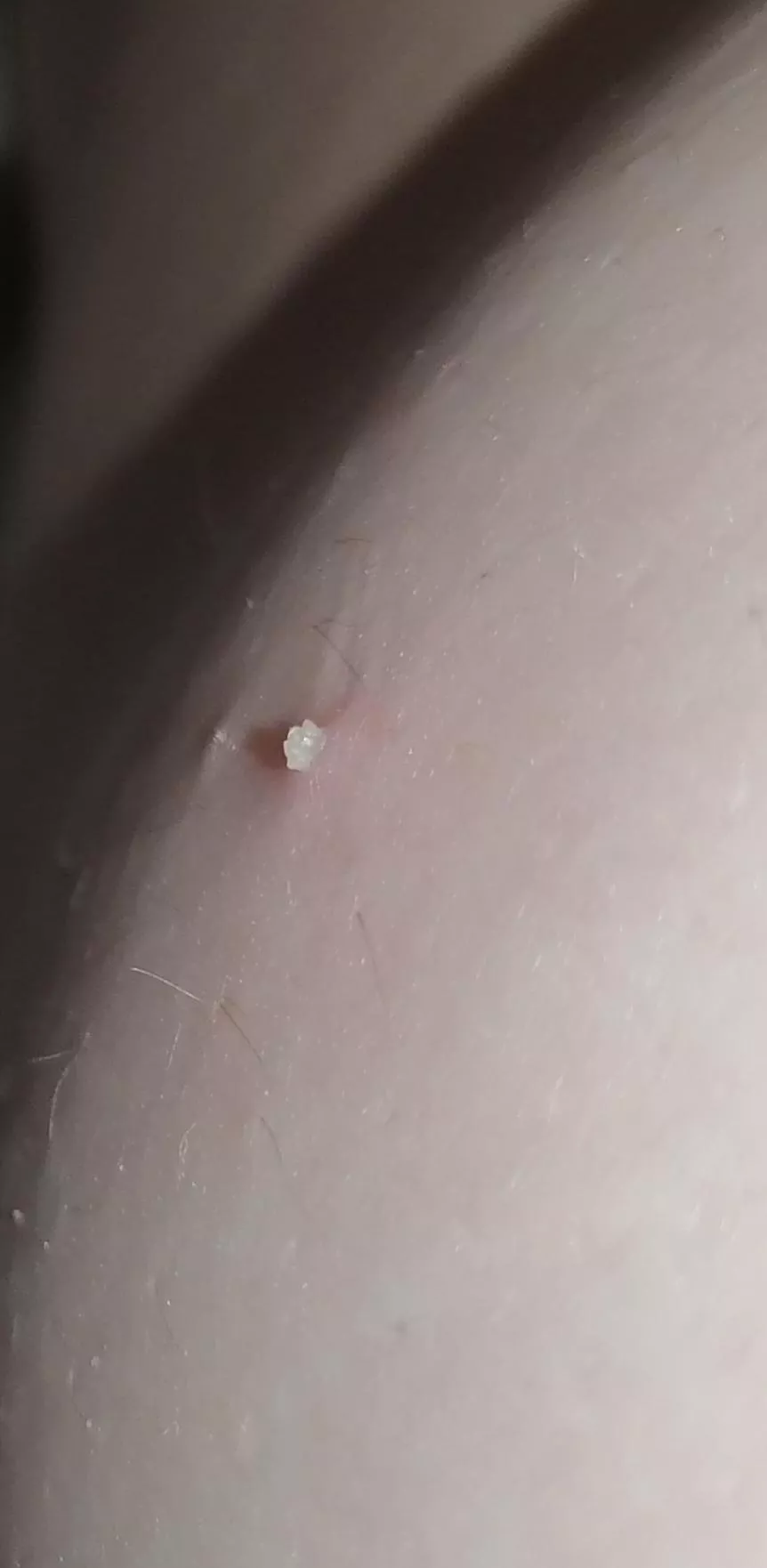 Small gem I found on the side of my boob