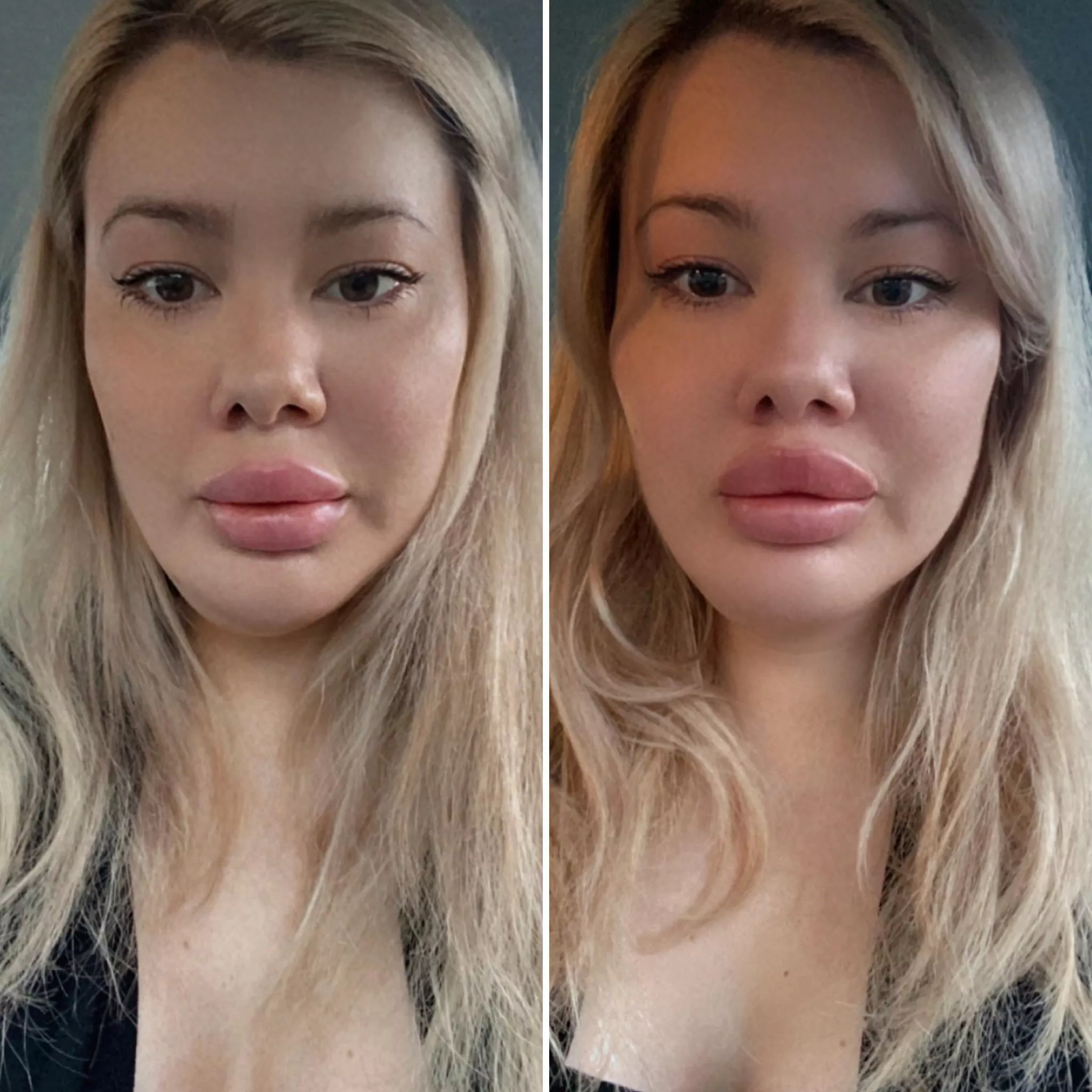 So excited by my new lips, cheek filler and Botox. I dribble without a straw and can’t wait for my frozen face to set in in the next day or so. 💉👄