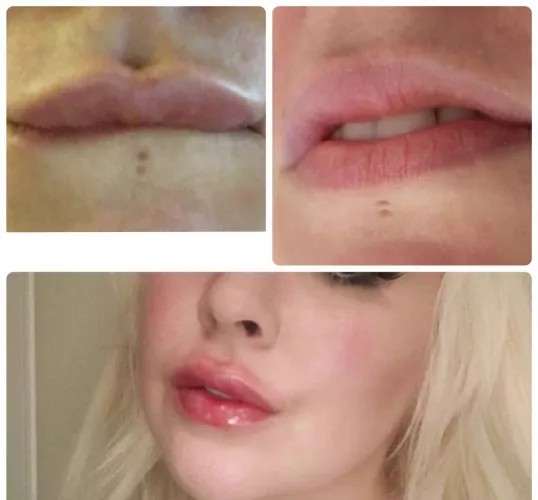 Some ilp filler progress, npte how I never had a Cupids Bow but skilled filling of the border has given me one! Pumping them up more on July 29th, now I have the shape its time go to go crazy with volume. Making good progress with my savings for a BA too