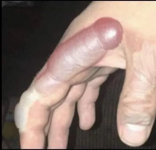 Spilled some hot liquid on my hand