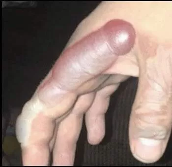 Spilled some hot liquid on my hand