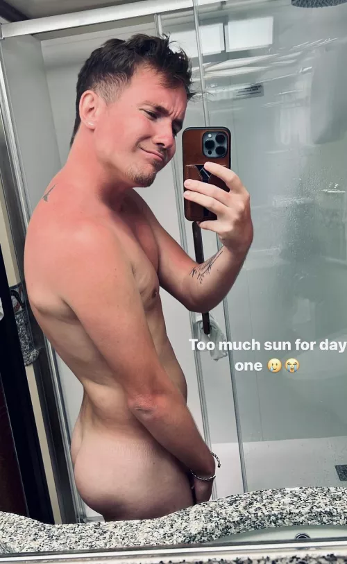 Sunburn