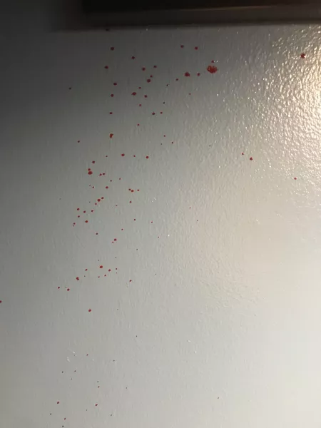Surprise chest cyst, Part 2. I put my phone down to handle the second pop and this is what came out. Surprise chest cyst, Part 2. I put my phone down to handle the second pop and this is what came out.