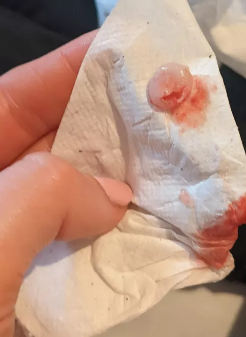 That hurt, but because it looks like the full capsule does that mean its just over? I have a hole in my head now but really hoping it doesn't grow back