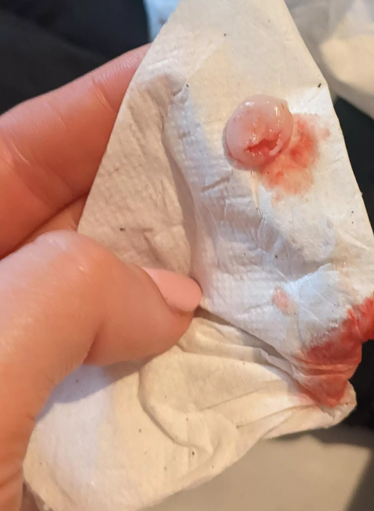 That hurt, but because it looks like the full capsule does that mean its just over? I have a hole in my head now but really hoping it doesn't grow back