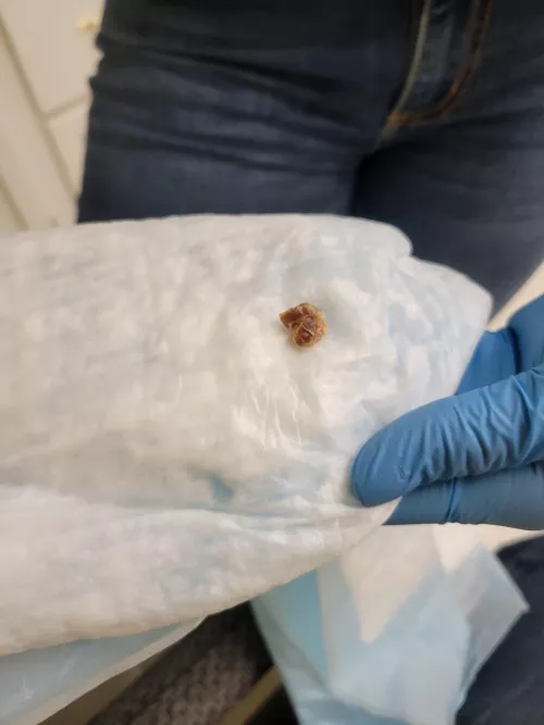 The stowaway. This came out of my ear today.