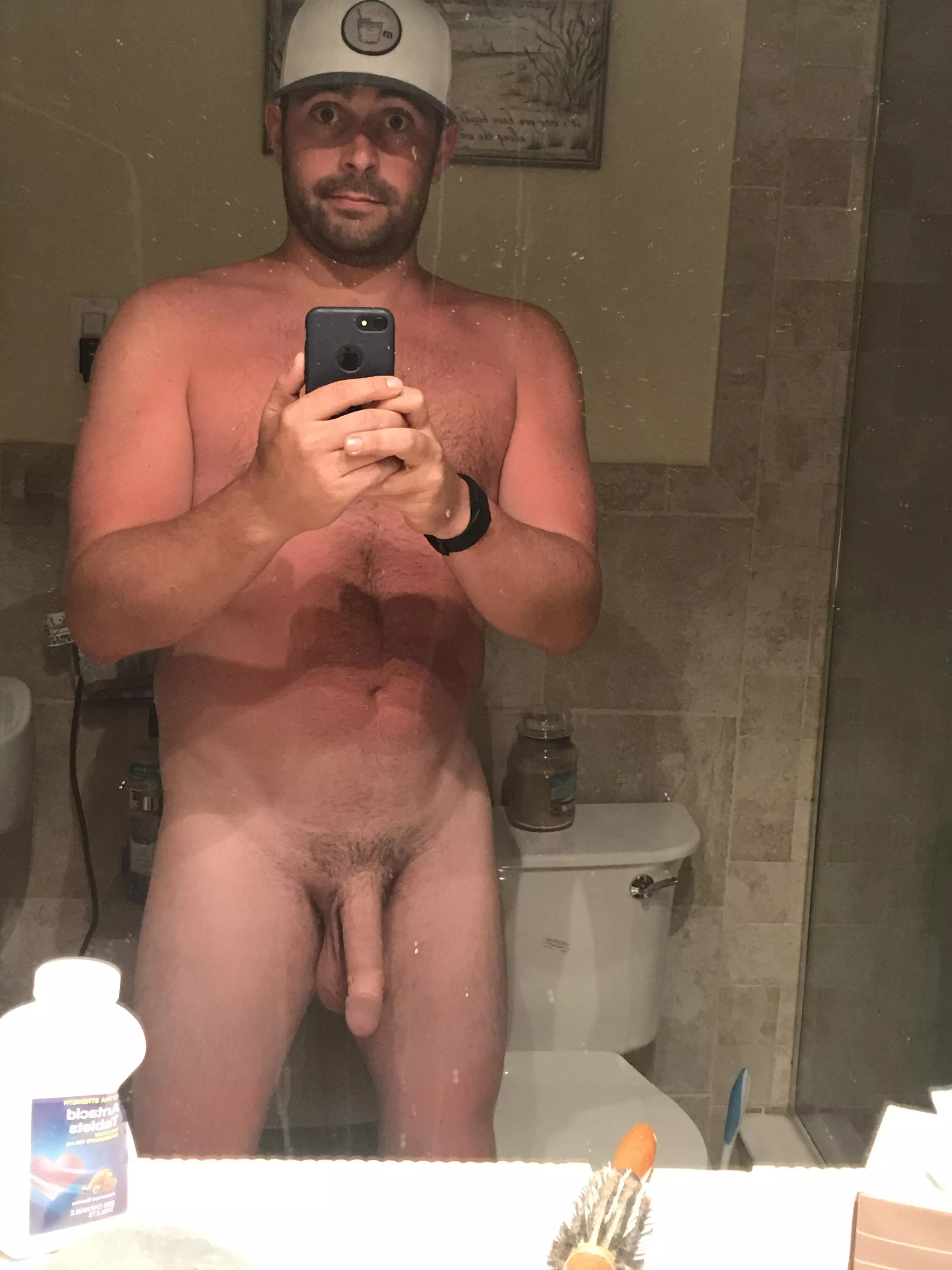 The sun attacked me.