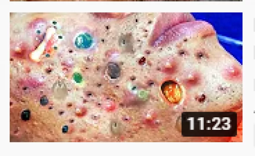 These thumbnails are getting out of control! Not gonna lie, I'd watch the heck out of colorful pimple pops!