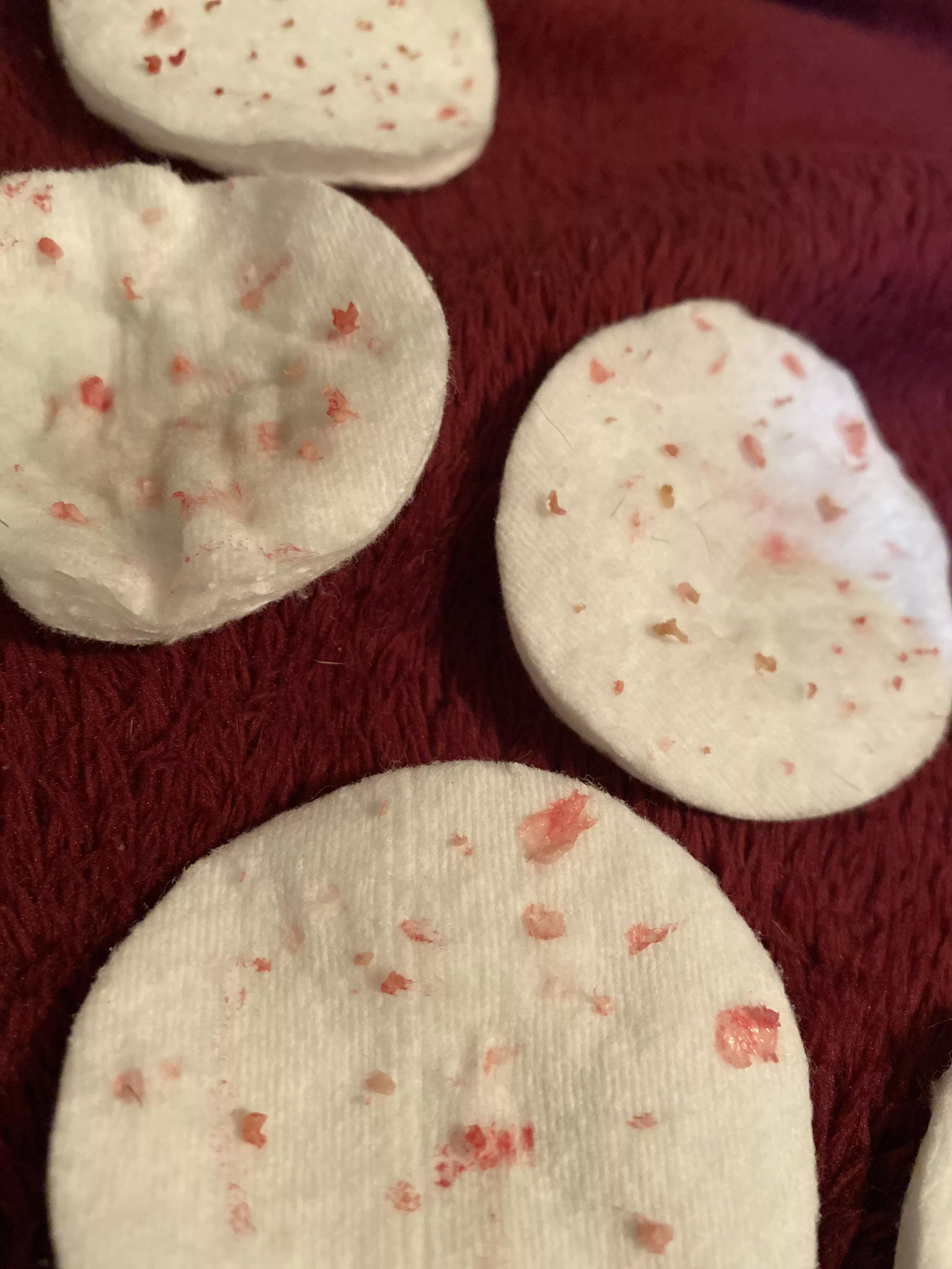 This is just a portion of all of the gunk I got out of my husband’s leg cyst. First time, no video, got the sac!