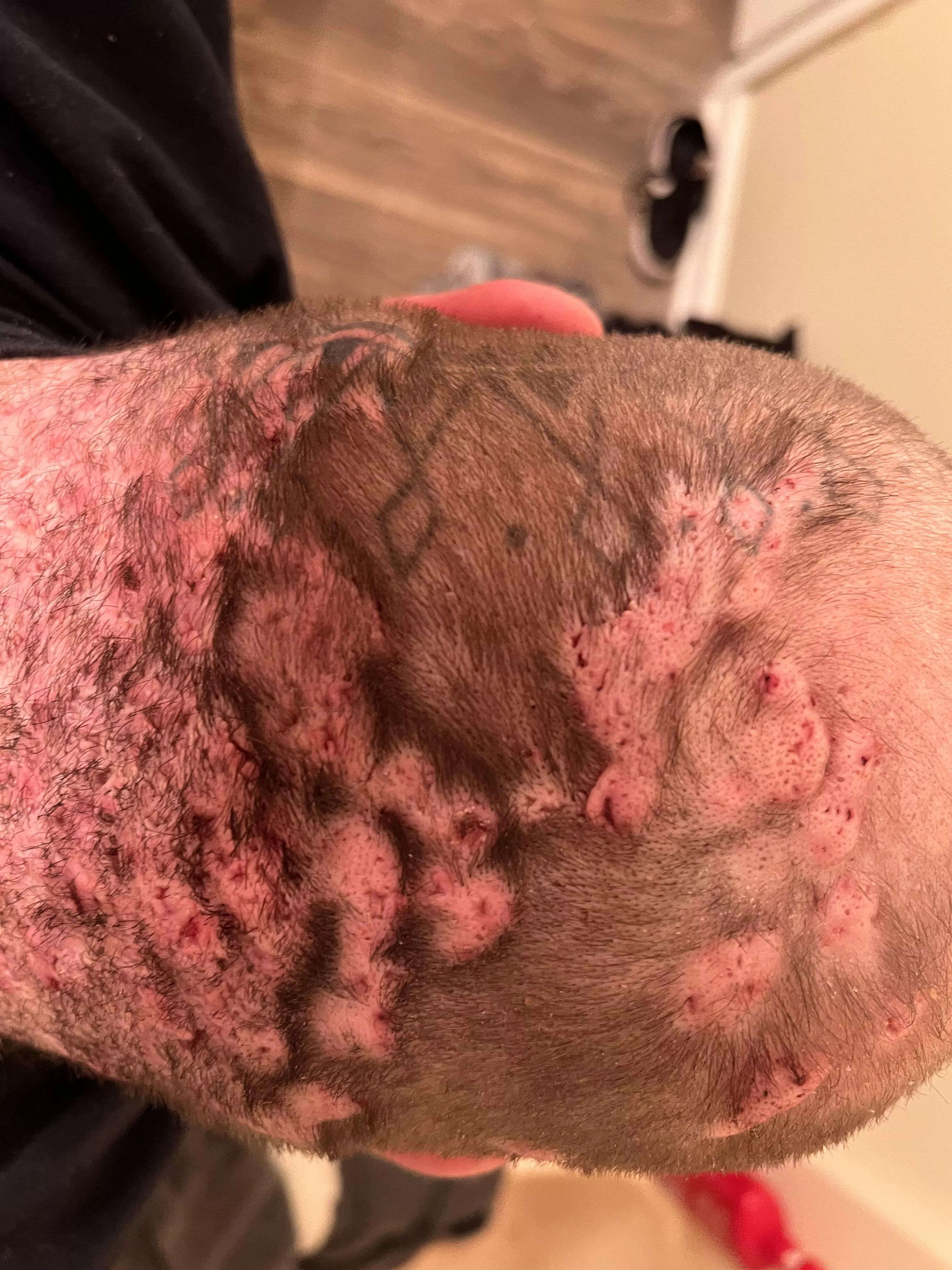 This is the back of my neck. No pops just bumps.
