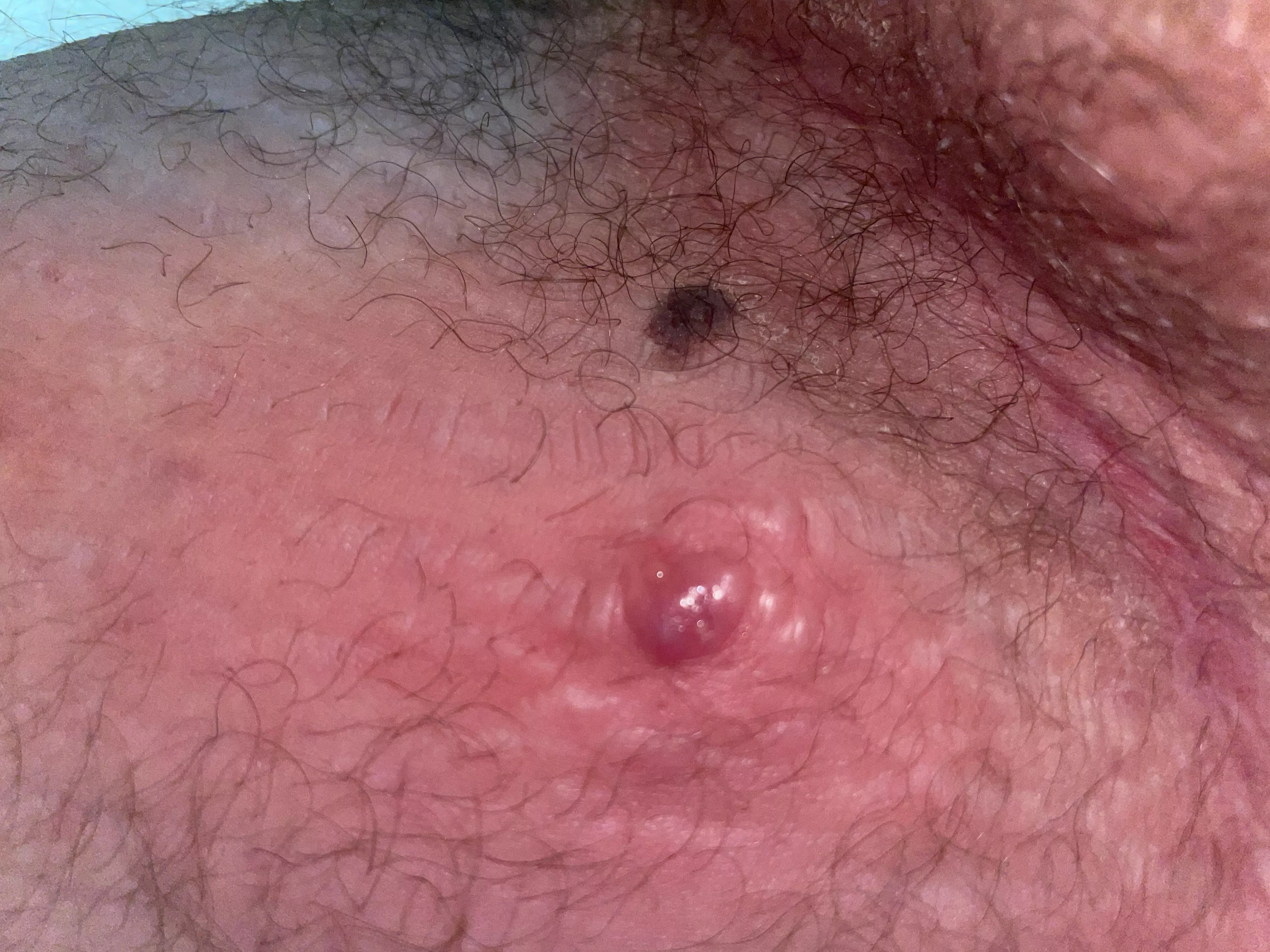 This little bastard popped up on my thigh yesterday, cyst I guess?