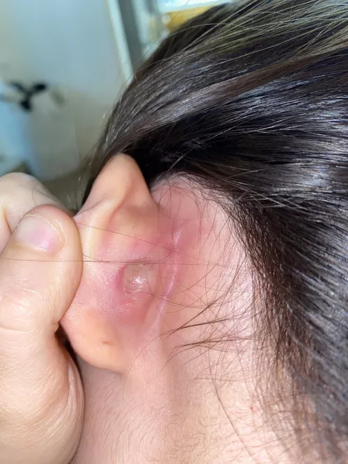 This mf hurts so bad but I wanna pop it😭😂 I don’t even know wtf it is I’m thinking a boil 🤷🏻‍♀️but when tf does it go away ahha