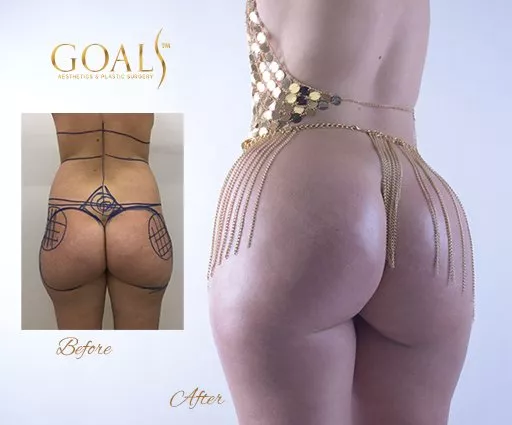 This plastic surgery clinic has the best photography for their before and after BBL photos! This plastic surgery clinic has the best photography for their before and after BBL photos!