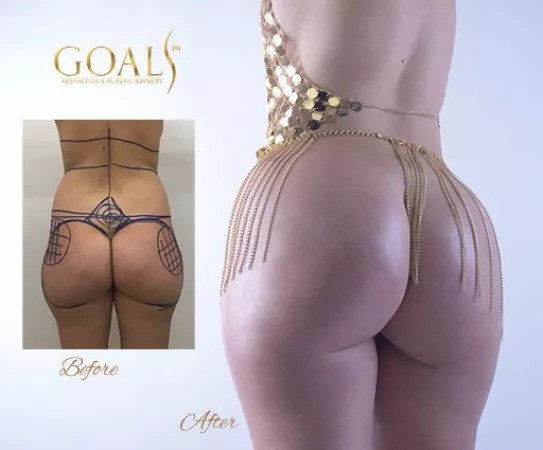 This plastic surgery clinic has the best photography for their before and after BBL photos! This plastic surgery clinic has the best photography for their before and after BBL photos!