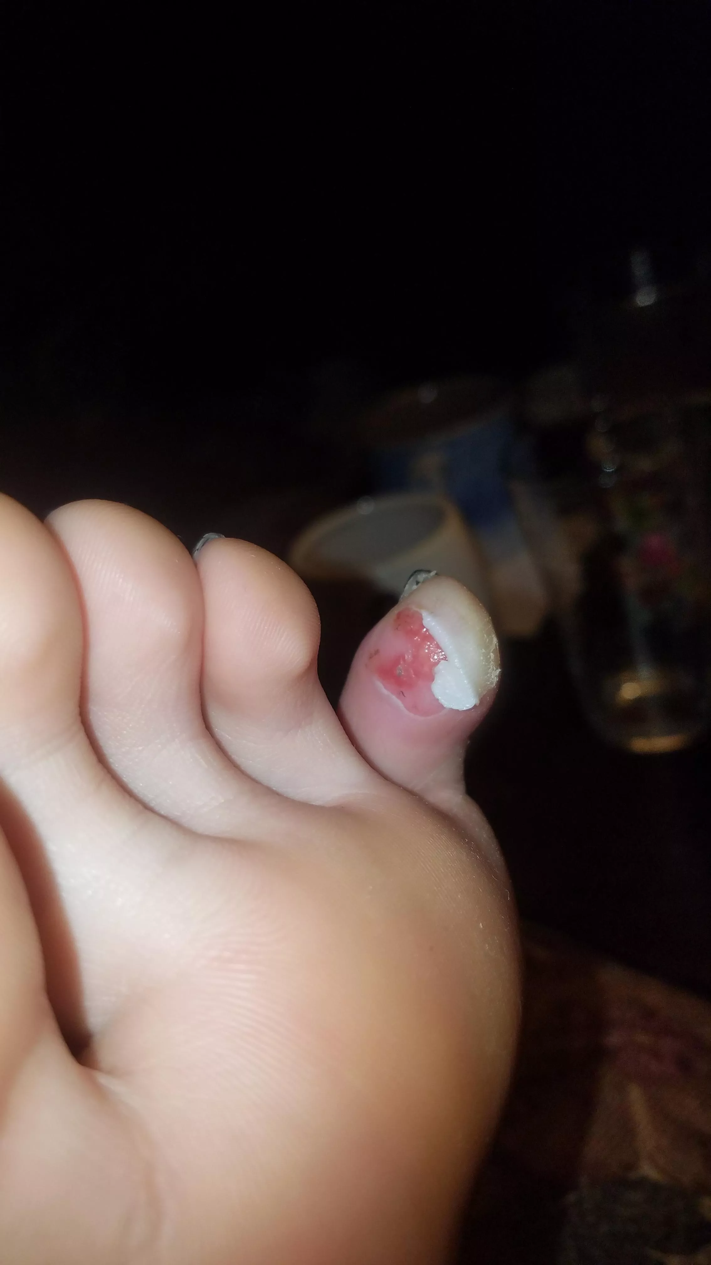 This raw blister that popped during the 3rd day on my new job.